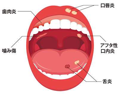 原因 口内炎