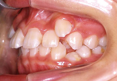 日本人の八重歯