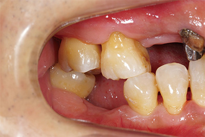 歯周病で歯茎が痩せた症例