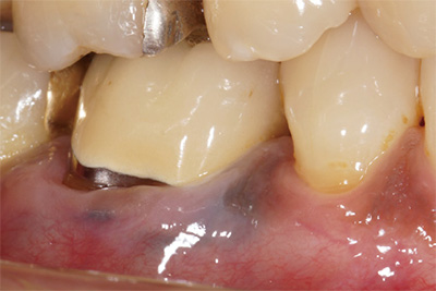 クラウンの金属の影響で歯肉が刺青のように紫色に変色