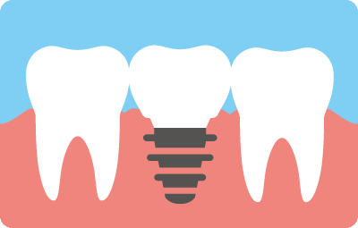 インプラント
