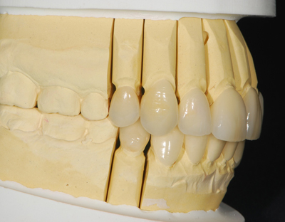 歯型をもとに、模型上でセラミッククラウン作製