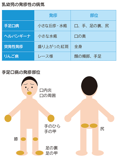 口、手足の発疹