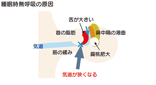 睡眠時無呼吸の原因