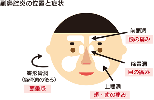 副鼻腔炎の位置と症状