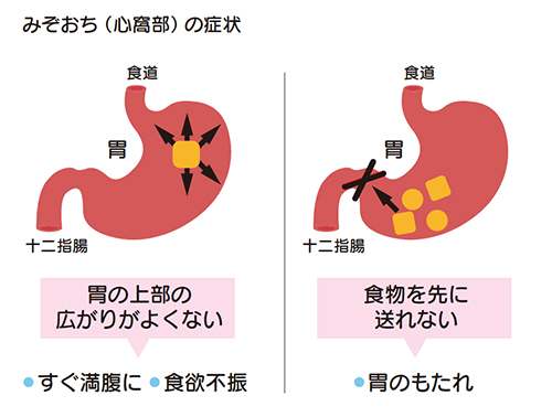 みぞおちの症状