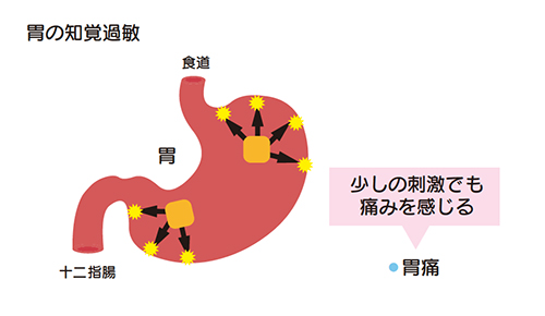 胃の知覚過敏