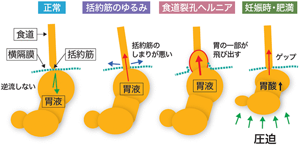 胃食道逆流症の原因