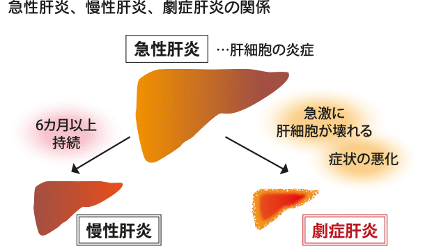 急性肝炎、慢性肝炎、劇症肝炎の関係