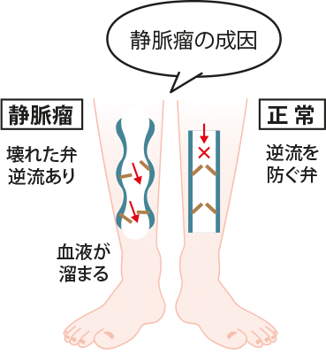 静脈瘤の成因