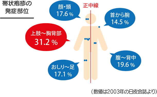 帯状疱疹の発症部位