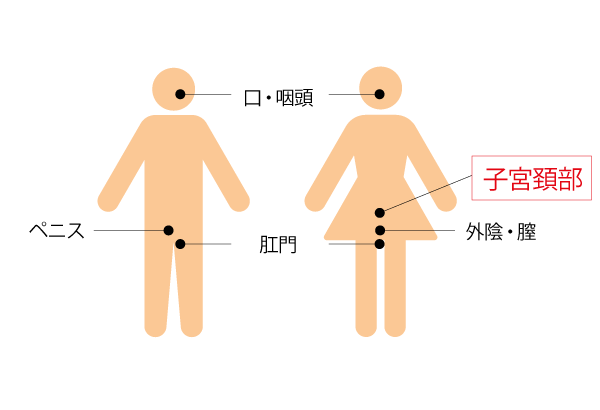 HPVが関与するがん疾患