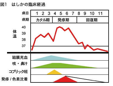 はしかの臨床経過