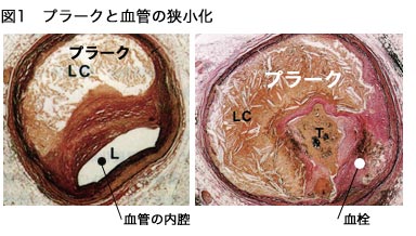 プラークと血管の狭小化