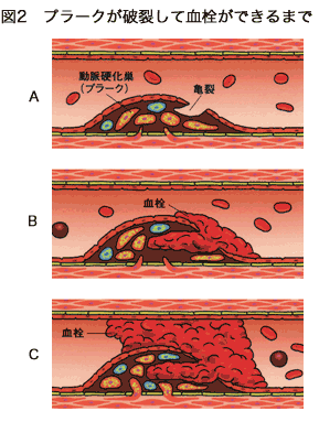 プラークが破裂して血栓ができるまで