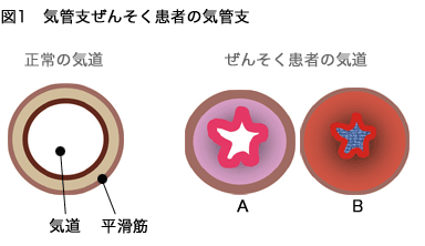 気管支ぜんそく患者の気管支