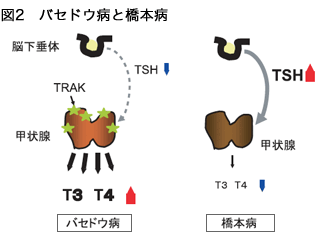 バセドウ病と橋本病