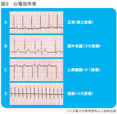 不整脈 子供