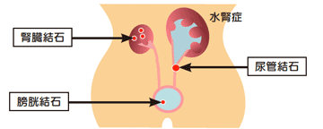 症状 結石