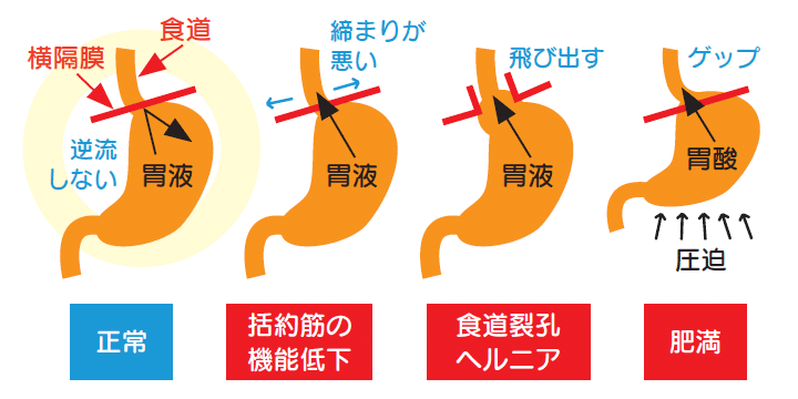 図1.　胃食道逆流症の原因