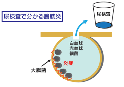 尿検査で分かる膀胱炎