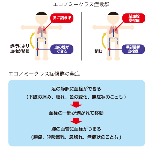 エコノミークラス症候群