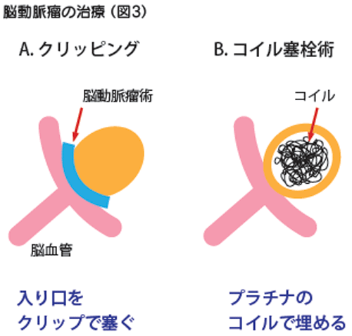 脳動脈瘤の治療