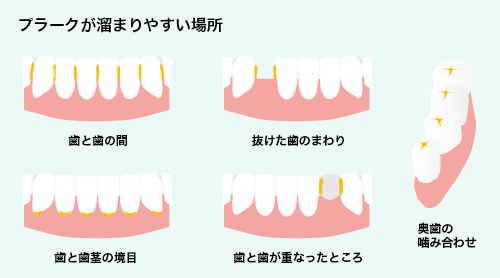 プラークが溜まりやすい場所