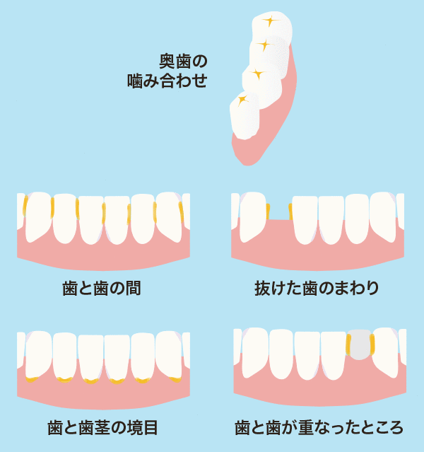 プラークが溜まりやすい場所